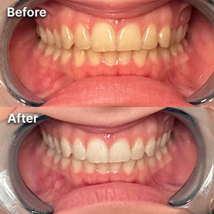 Caeloria Teeth Whitening Powder™