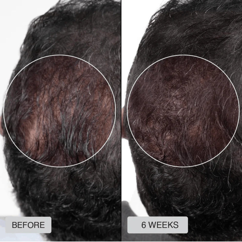 Red Light Therapy Cap for Hair Regrowth Treatments