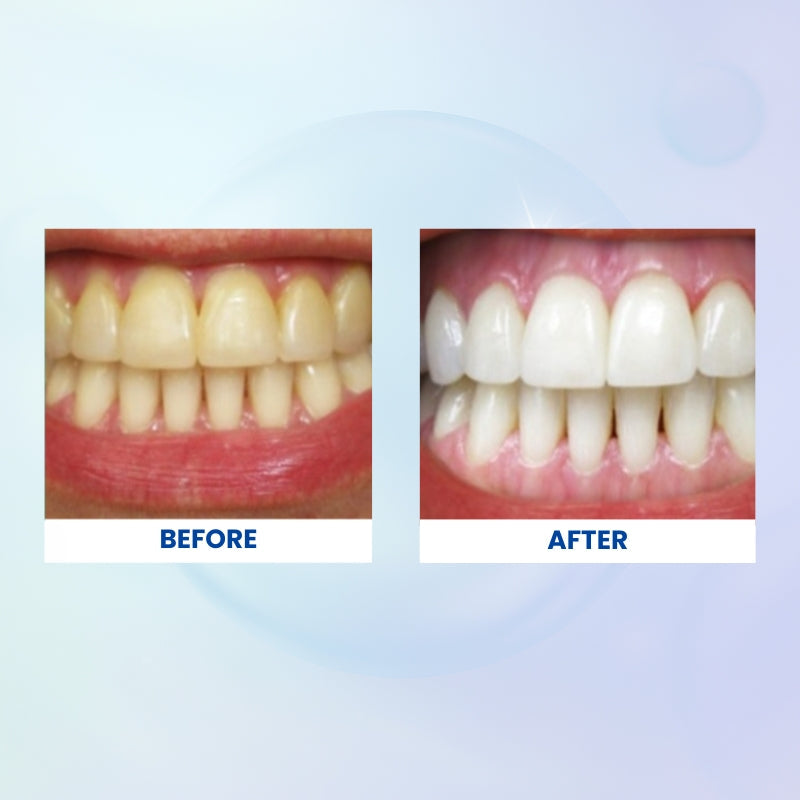 Whitening Strips